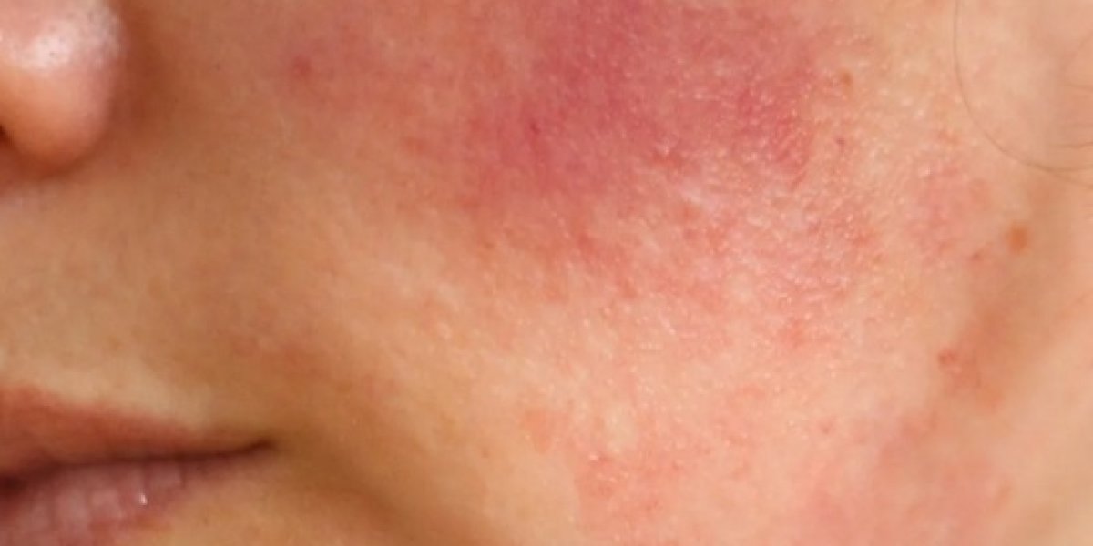 Холодовой дерматит: врачи назвали, у кого начнется «аллергия на мороз» этой зимой Холодовой дерматит: врачи назвали, у кого начнется «аллергия на мороз» этой зимой